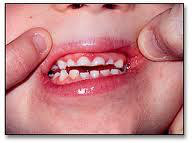 Children teeth Grinding